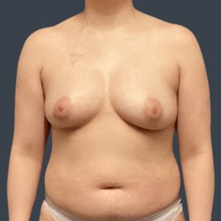Implant Breast Reconstruction Before & After Gallery - Patient 324780 - Image 2