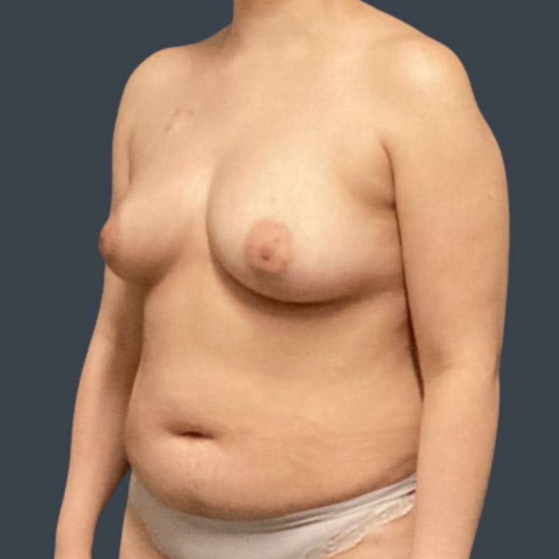 Implant Breast Reconstruction Before & After Gallery - Patient 324780 - Image 4