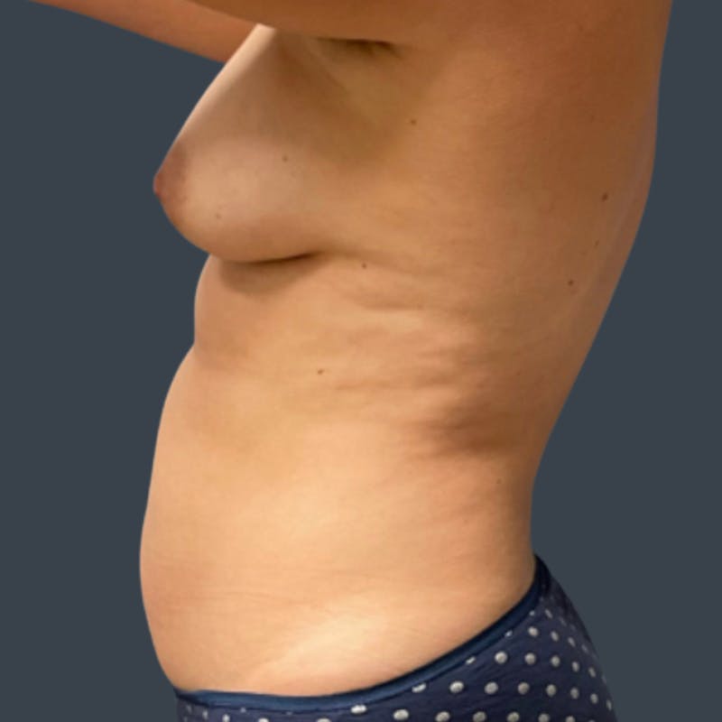 Fat Grafting Breast Augmentation Before & After Gallery - Patient 203881 - Image 3
