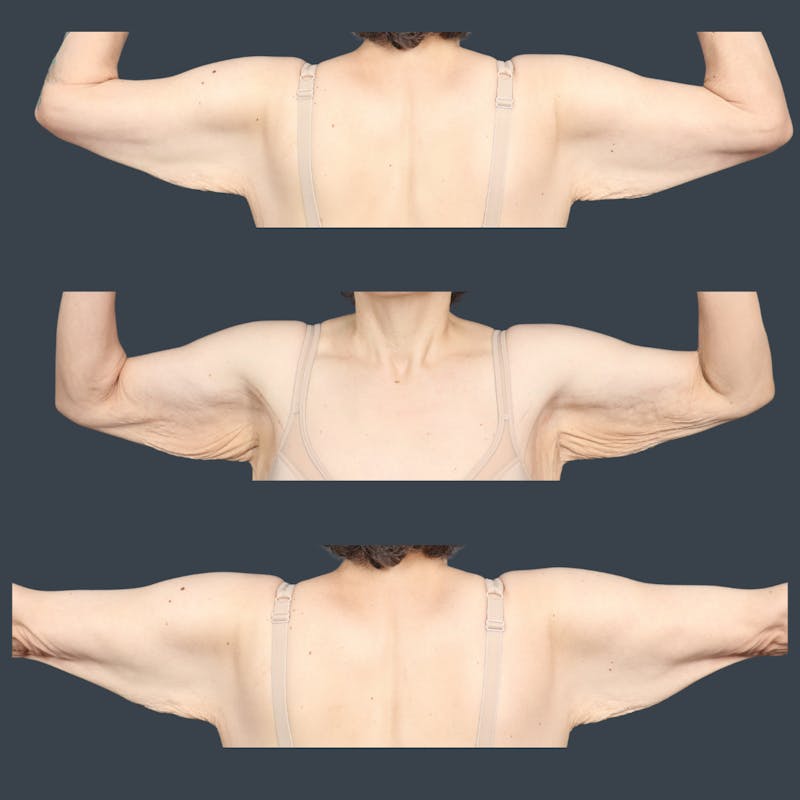 Arm Lift Before & After Gallery - Patient 348396 - Image 1