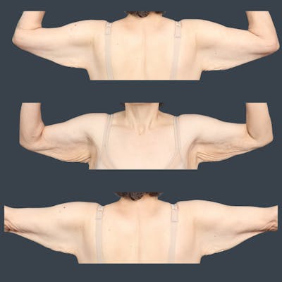 Arm Lift Before & After Gallery - Patient 348396 - Image 1