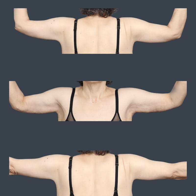 Arm Lift Before & After Gallery - Patient 348396 - Image 2
