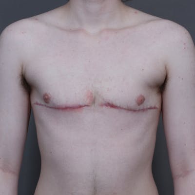 Flat Closure Before & After Gallery - Patient 469582 - Image 2