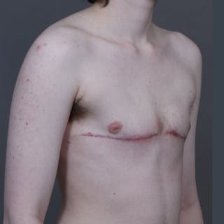 Flat Closure Before & After Gallery - Patient 469582 - Image 4