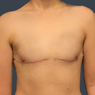Flat Closure Before & After Gallery - Patient 180838 - Image 2