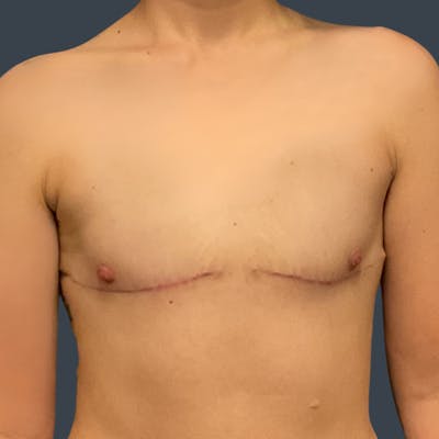 Flat Closure Before & After Gallery - Patient 180838 - Image 2