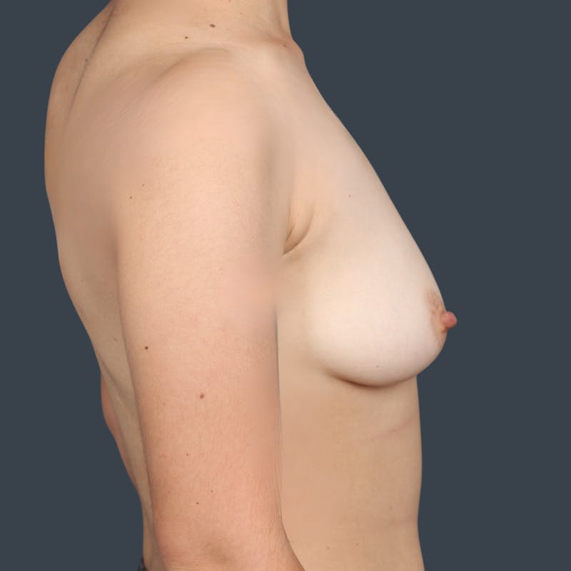 Flat Closure Before & After Gallery - Patient 180838 - Image 3