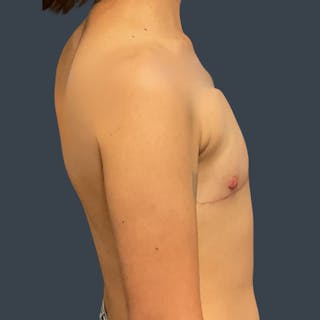 Flat Closure Before & After Gallery - Patient 180838 - Image 4