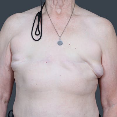 Flat Closure Before & After Gallery - Patient 142584 - Image 1