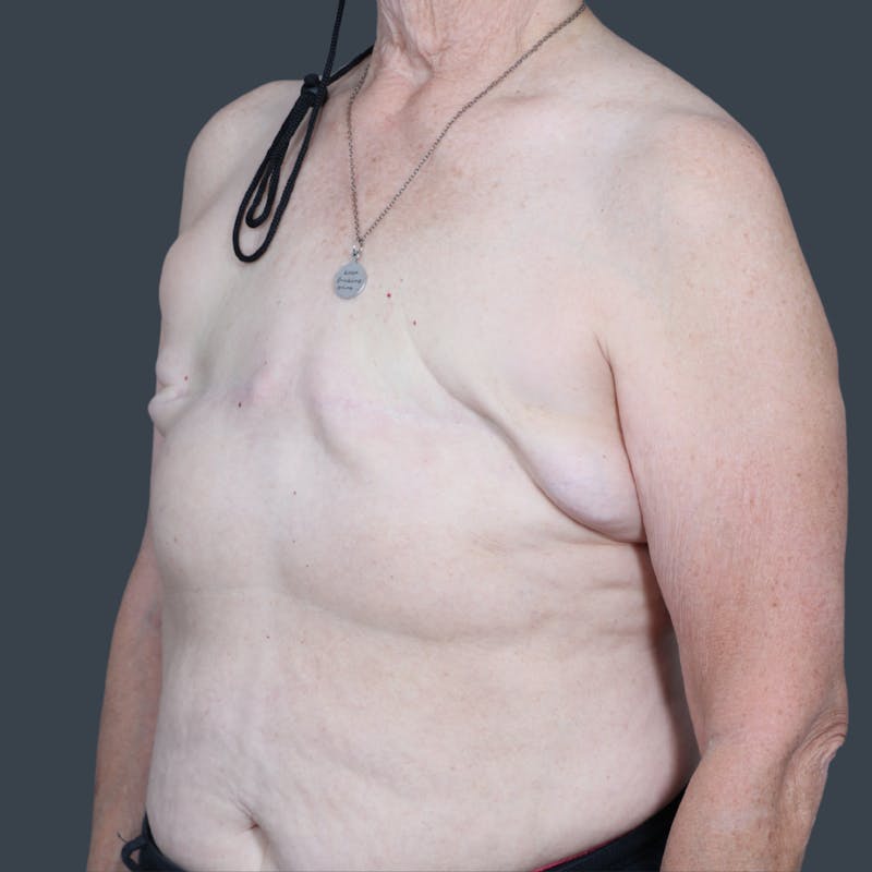 Flat Closure Before & After Gallery - Patient 142584 - Image 3