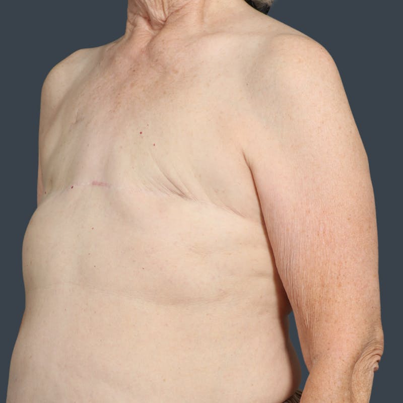 Flat Closure Before & After Gallery - Patient 142584 - Image 4