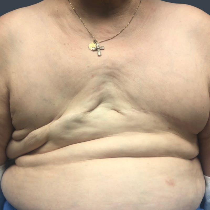 Flat Closure Before & After Gallery - Patient 231676 - Image 1