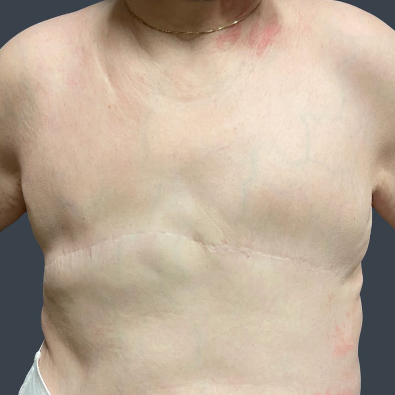 Flat Closure Before & After Gallery - Patient 231676 - Image 2