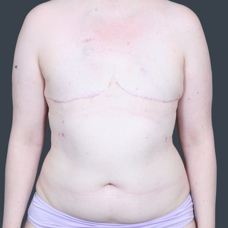 Hybrid Breast Reconstruction Before & After Gallery - Patient 229445 - Image 1