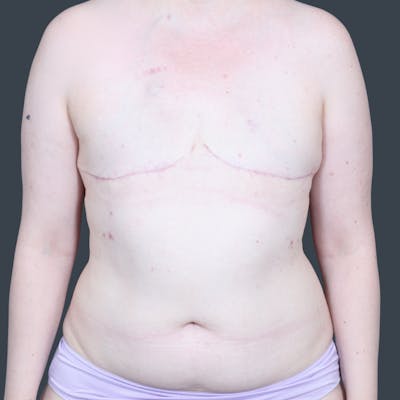 Hybrid Breast Reconstruction Before & After Gallery - Patient 229445 - Image 1