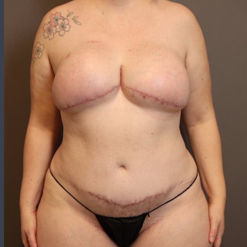 Hybrid Breast Reconstruction Before & After Gallery - Patient 229445 - Image 4