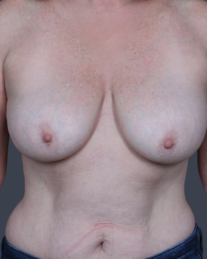 Oncoplastic/Lumpectomy Reconstruction Before & After Gallery - Patient 131165 - Image 1