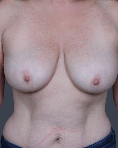 Oncoplastic/Lumpectomy Reconstruction Before & After Gallery - Patient 131165 - Image 1