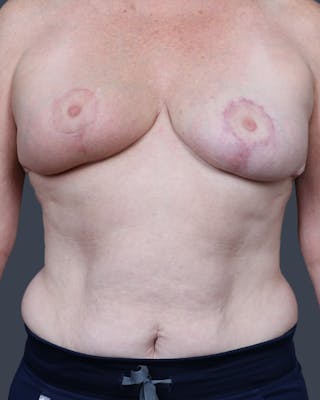 Oncoplastic/Lumpectomy Reconstruction Before & After Gallery - Patient 131165 - Image 2
