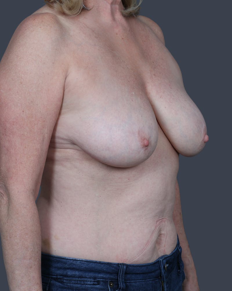 Oncoplastic/Lumpectomy Reconstruction Before & After Gallery - Patient 131165 - Image 3