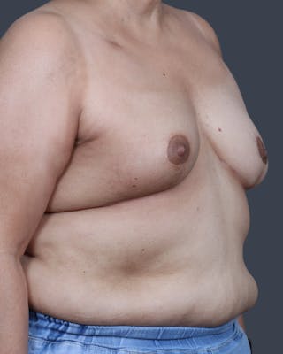 Oncoplastic/Lumpectomy Reconstruction Before & After Gallery - Patient 172736 - Image 4