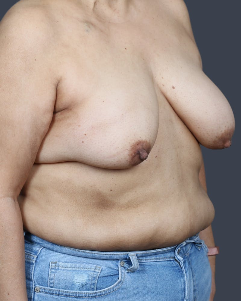 Oncoplastic/Lumpectomy Reconstruction Before & After Gallery - Patient 172736 - Image 3