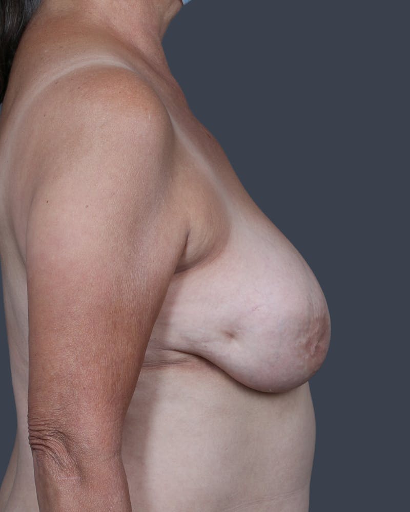 Oncoplastic/Lumpectomy Reconstruction Before & After Gallery - Patient 325693 - Image 3