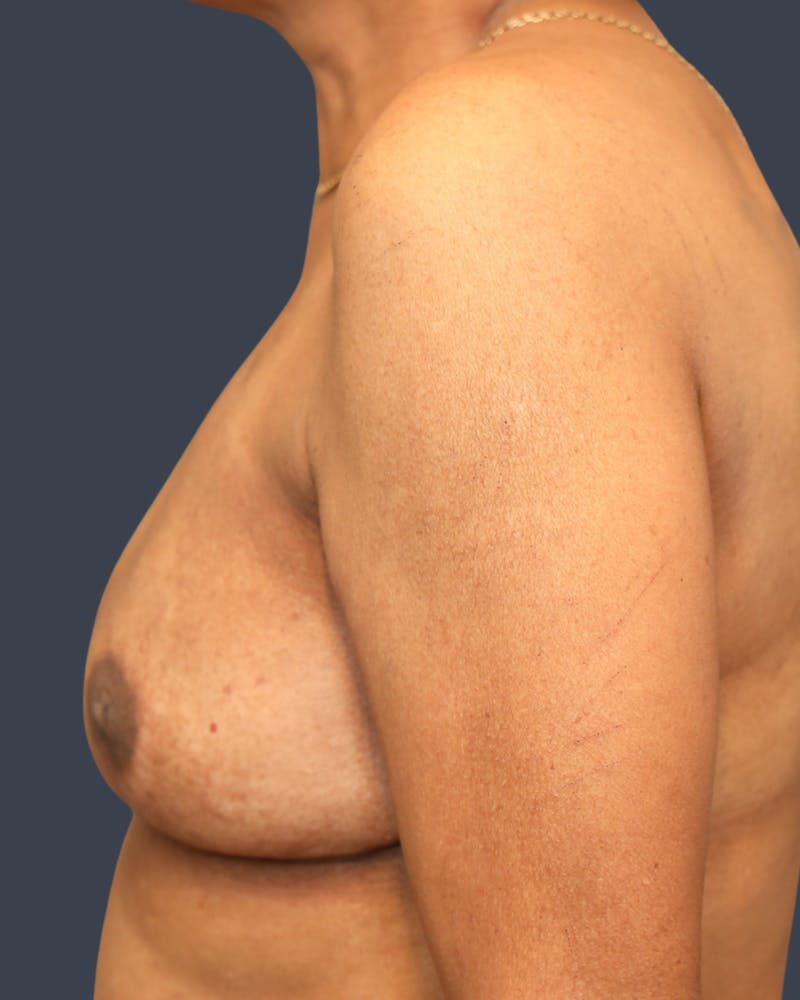 Oncoplastic/Lumpectomy Reconstruction Before & After Gallery - Patient 311942 - Image 4