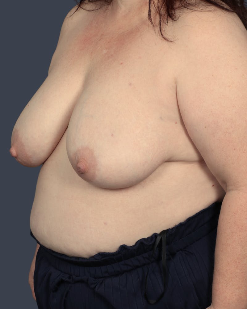 Oncoplastic/Lumpectomy Reconstruction Before & After Gallery - Patient 394910 - Image 3