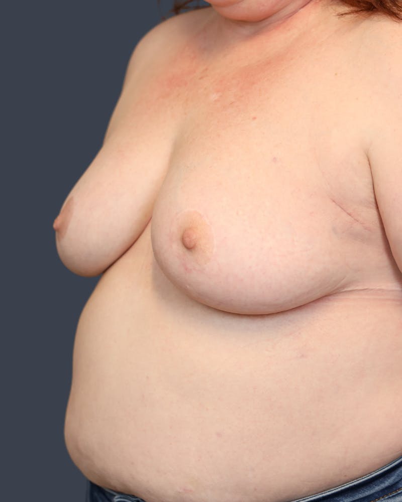 Oncoplastic/Lumpectomy Reconstruction Before & After Gallery - Patient 394910 - Image 4