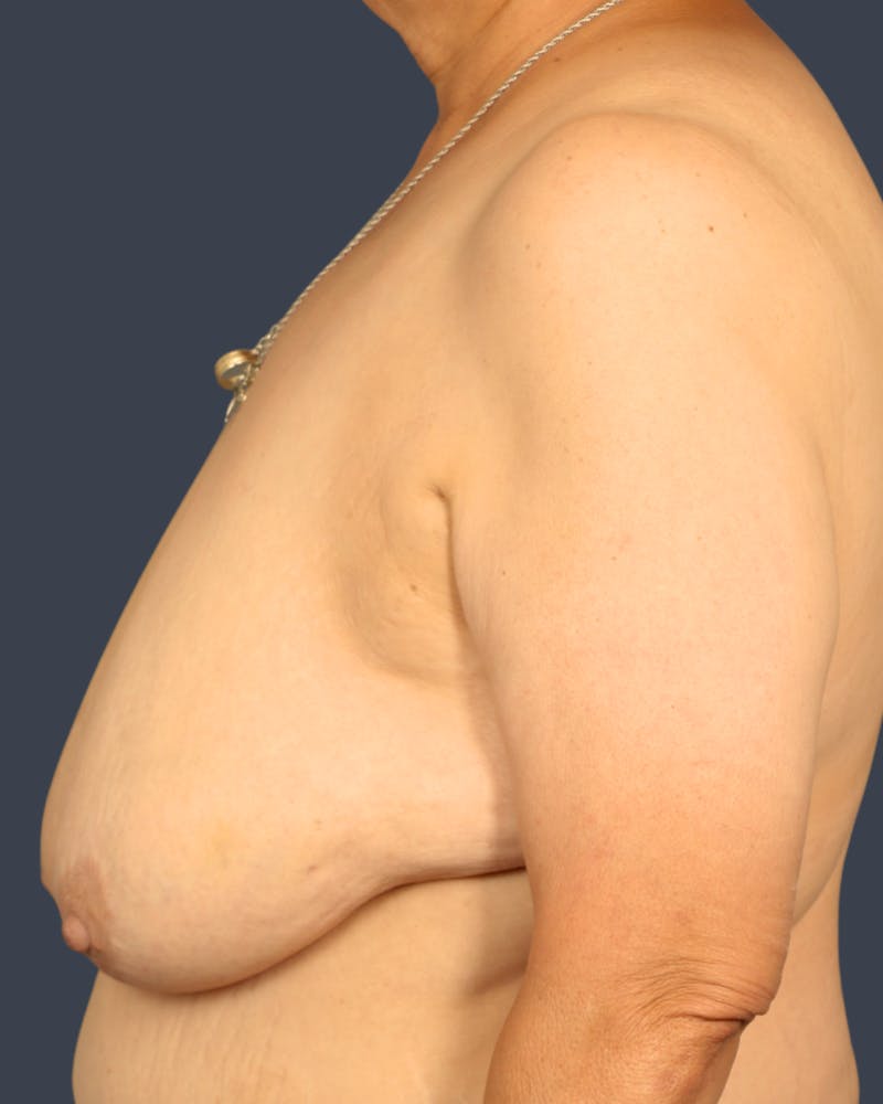 Breast Augmentation Before & After Gallery - Patient 135563 - Image 3