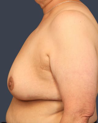 Breast Augmentation Before & After Gallery - Patient 135563 - Image 4