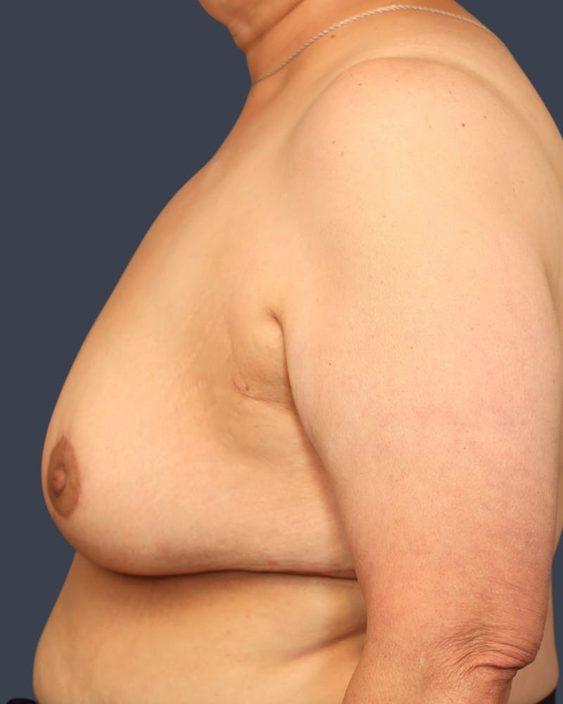 Breast Augmentation Before & After Gallery - Patient 135563 - Image 4