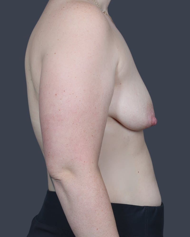 Breast Lift Before & After Gallery - Patient 343848 - Image 3