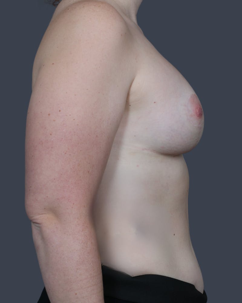 Breast Lift Before & After Gallery - Patient 343848 - Image 4