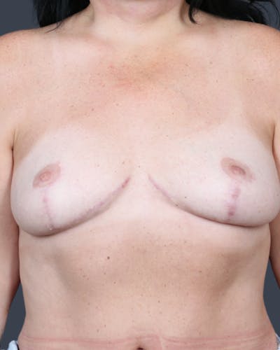 Breast Lift Before & After Gallery - Patient 366500 - Image 2