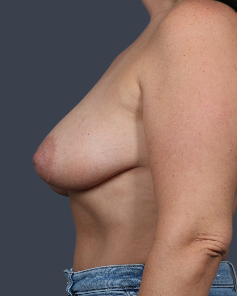 Breast Lift Before & After Gallery - Patient 366500 - Image 3
