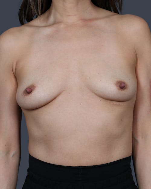 Before procedure image for Breast Augmentation