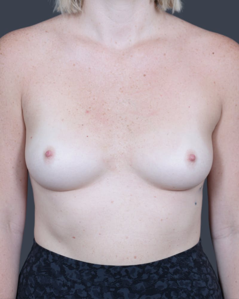 Breast Augmentation Before & After Gallery - Patient 405389 - Image 1