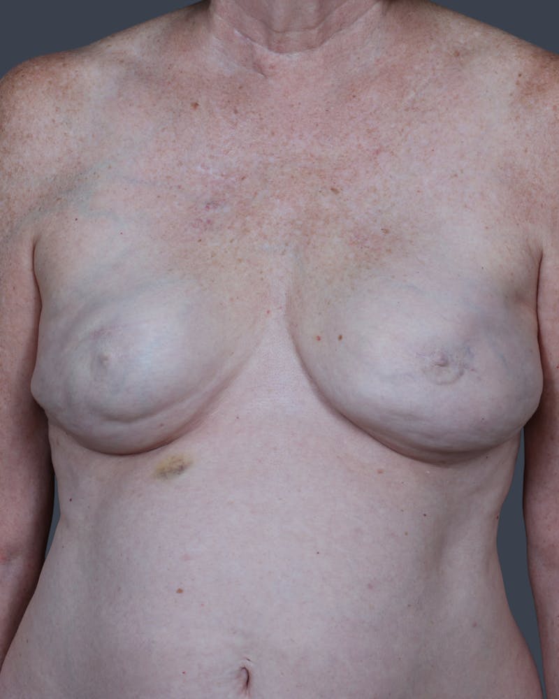 Implant Breast Reconstruction Before & After Gallery - Patient 866254 - Image 1