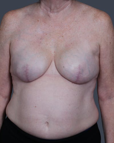 Implant Breast Reconstruction Before & After Gallery - Patient 866254 - Image 2