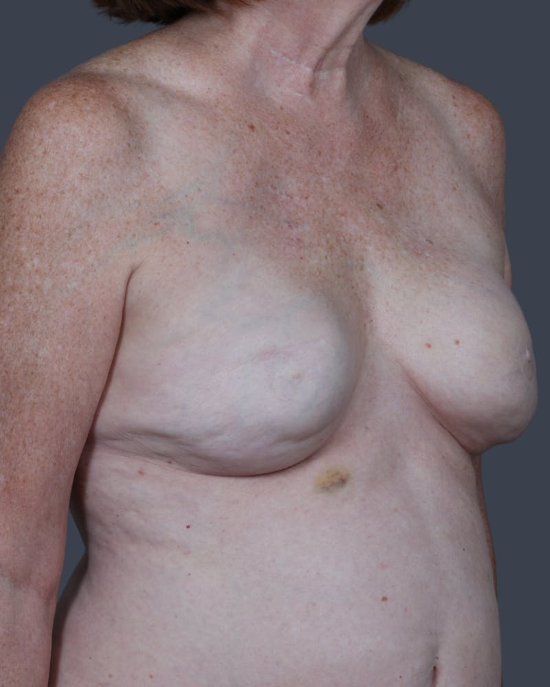 Implant Breast Reconstruction Before & After Gallery - Patient 866254 - Image 3