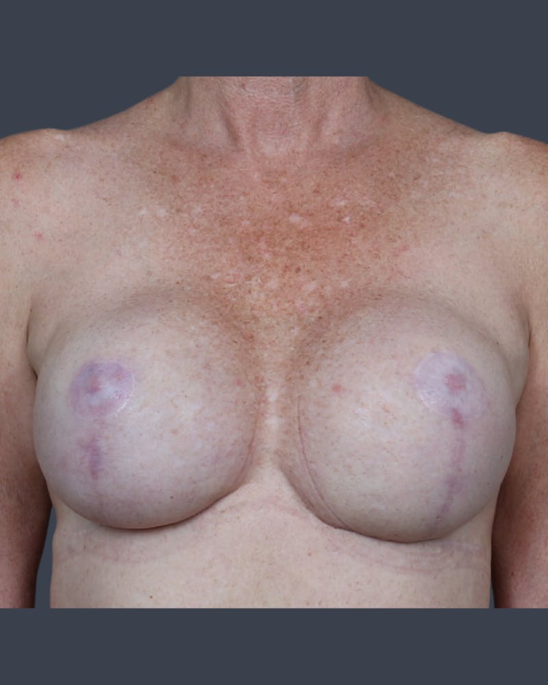 Implant Breast Reconstruction Before & After Gallery - Patient 489187 - Image 1