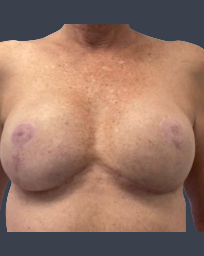 Implant Breast Reconstruction Before & After Gallery - Patient 489187 - Image 2