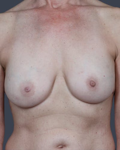 Implant Breast Reconstruction Before & After Gallery - Patient 421237 - Image 1