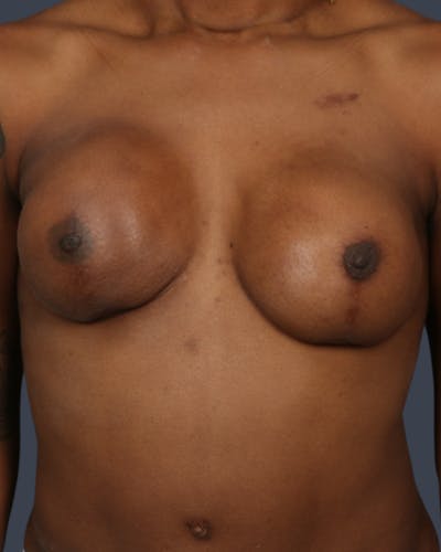 Implant Breast Reconstruction Before & After Gallery - Patient 261568 - Image 1