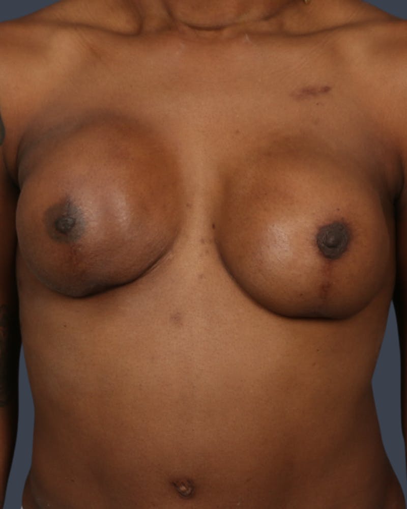 Implant Breast Reconstruction Before & After Gallery - Patient 261568 - Image 1