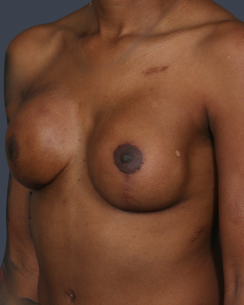 Implant Breast Reconstruction Before & After Gallery - Patient 261568 - Image 4
