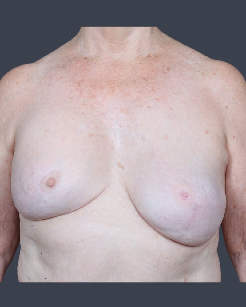 Implant Breast Reconstruction Before & After Gallery - Patient 153195 - Image 2