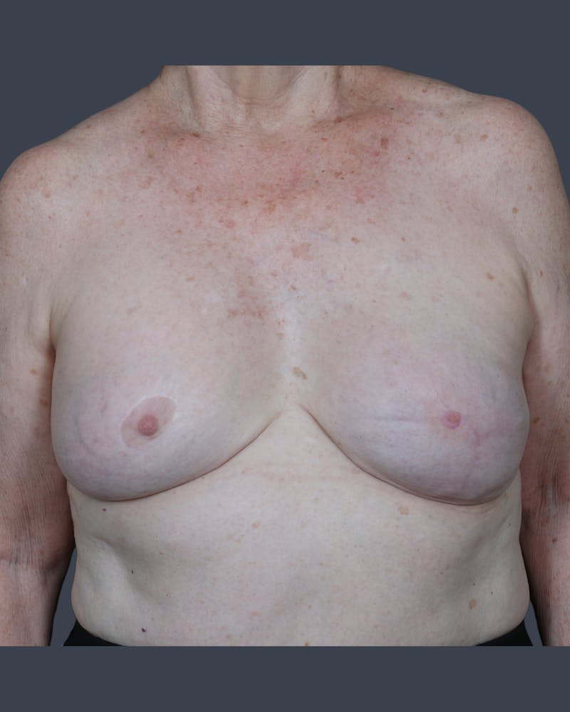Implant Breast Reconstruction Before & After Gallery - Patient 153195 - Image 1